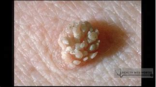 Image result for Genital Warts during Pregnancy
