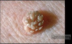 Image result for Male Genital Warts