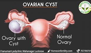 Image result for Pregnancy Cyst Ovary