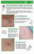 Image result for Molluscum Contagiosum Beetlejuice Blister