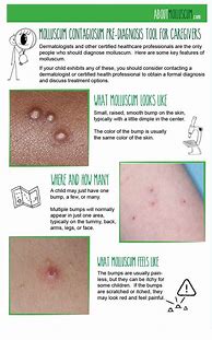Image result for Treatment for Molluscum Contagiosum in Toddlers