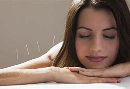 Image result for Picture of Acupuncture