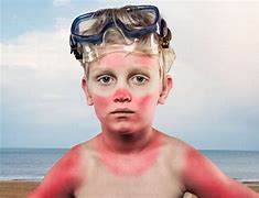 Image result for SunBurn for Kids