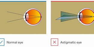 Image result for Astigmatism Operation