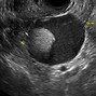 Image result for Dermoid Plug Ultrasound