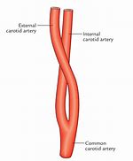 Image result for Carotid Web