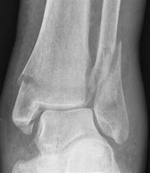 Image result for Toller Broken Foot