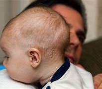 Image result for Craniosynostosis