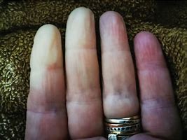 Image result for Hand Arm Vibration Gangrene
