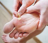 Image result for Plantar Wart Coming Out