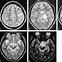 Image result for Encephalitis Brain CT Scan