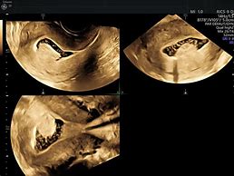 Image result for Fibroid Uterus Ultrasound