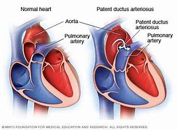 Image result for Pulmonary Artery PDA