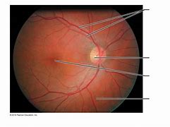 Image result for Posterior Fundus