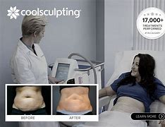 Image result for CoolSculpting Price List