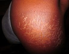 Image result for SunBurn On Black Skin