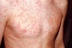 Image result for Viral Skin Rashes in Adults