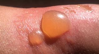 Image result for SunBurn Blister Treatment