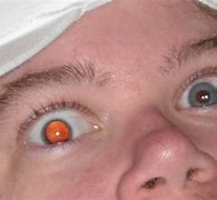 Image result for Lasik Eye Surgery for Astigmatism