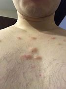 Image result for Cyst On Chest