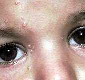 Image result for Molluscum On Face Child