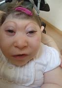 Image result for Anencephalic Infant