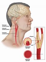 Image result for Twisted Carotid Artery Neck