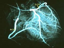 Image result for Atherosclerosis in Hand On XR