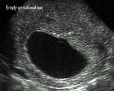 Image result for Gestational Age 9 Weeks