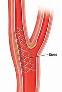 Image result for Stenting Carotid Artery in Elderly
