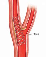 Image result for Carotid Artery Stent Placement