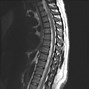 Image result for Spinal Arachnoid Cyst