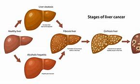 liver cancer 的图像结果