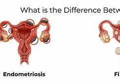 Image result for Fibroids vs Endometriosis
