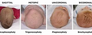 Image result for Craniosynostosis Head Shapes