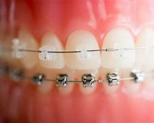 Image result for Byte Invisible Braces