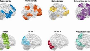 Image result for Bipolar Brain vs Normal