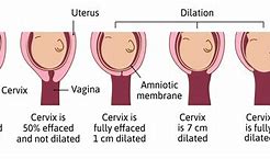 Image result for 1 Cm Dilated Cervix