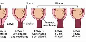 Image result for 2 Cm Dilated Induction