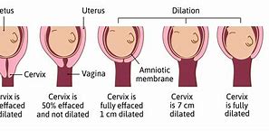 Image result for Dilated at 36 Weeks Pregnant