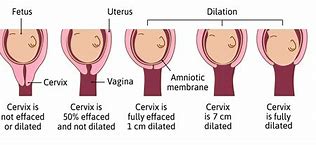 Image result for What Is 10 Cm Dilated Look Like