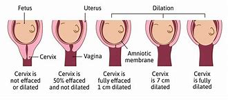 Image result for Woman 10 Cm Dilated