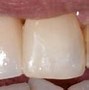 Image result for Parts of Dental Bridge