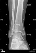 Image result for Normal Foot X-ray