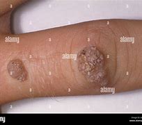 Image result for Papilloma Warts