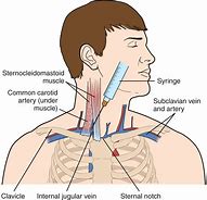 Image result for Central Venous Canulation