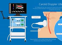 Image result for Carotid Artery Ultrasound Screening