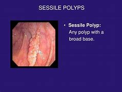 Image result for Sessile Polyp 3Mm