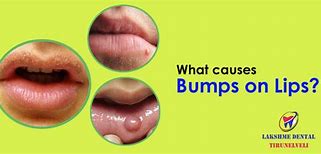 Image result for Allergic Reaction Swollen Upper Lip
