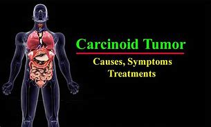 Image result for Carcinoid Tumor Symptoms
